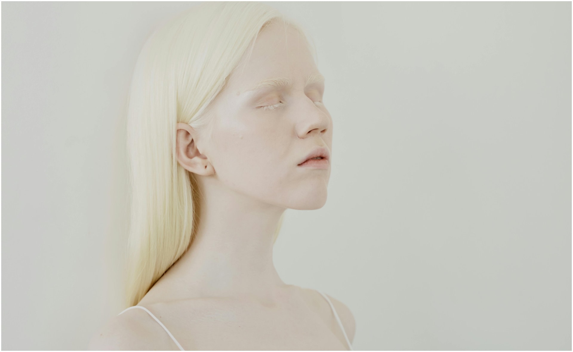 žena s albinizmom