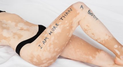 Uznávaný lekár prezradil, či hrozí vitiligo aj tebe