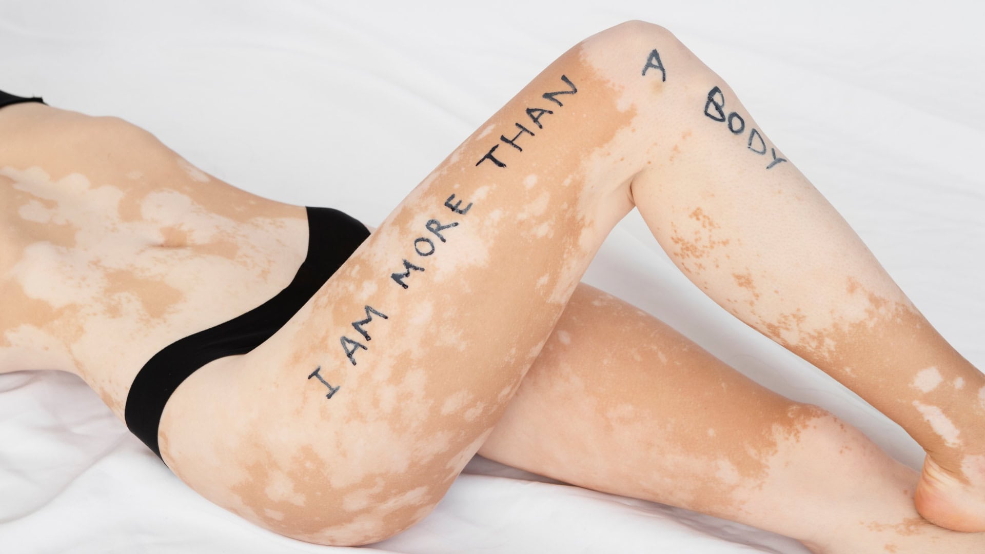 Uznávaný lekár prezradil, či hrozí vitiligo aj tebe